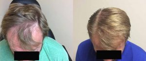 before and after hair loss treatment photo